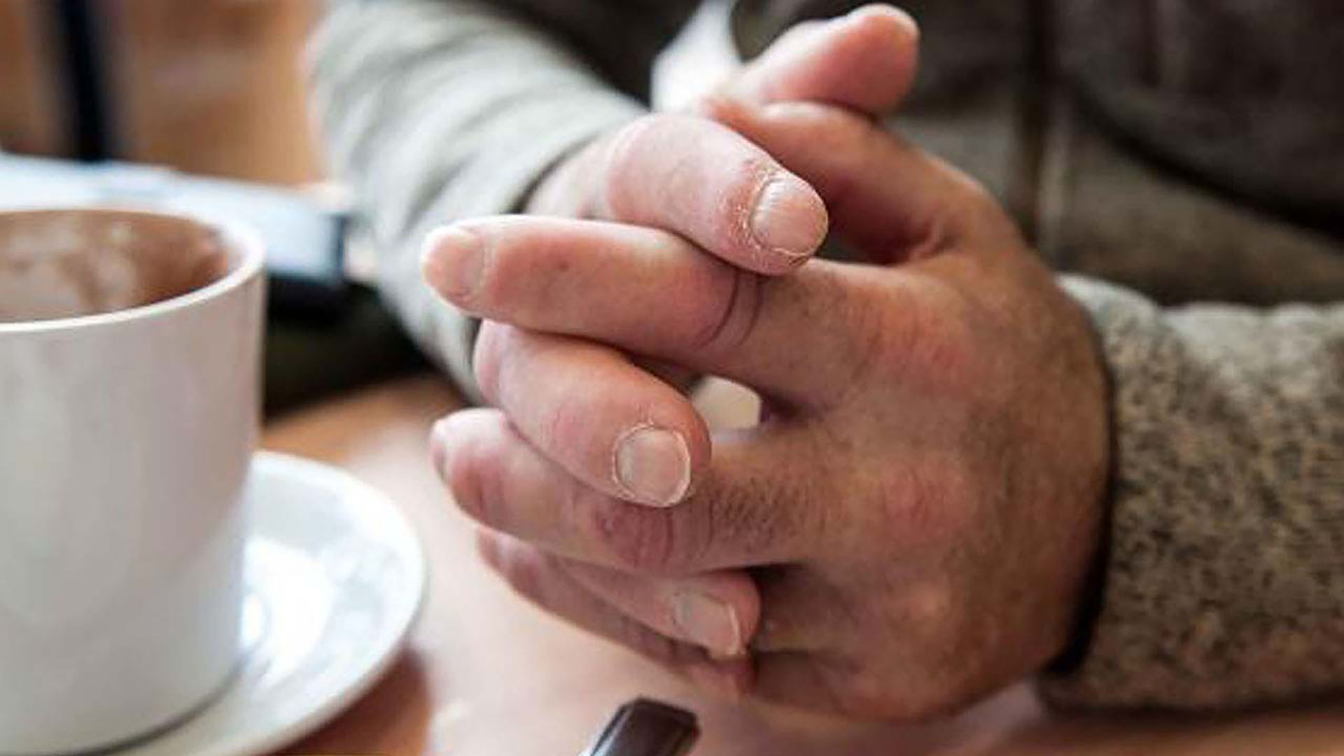 Svullna händer och fingrar