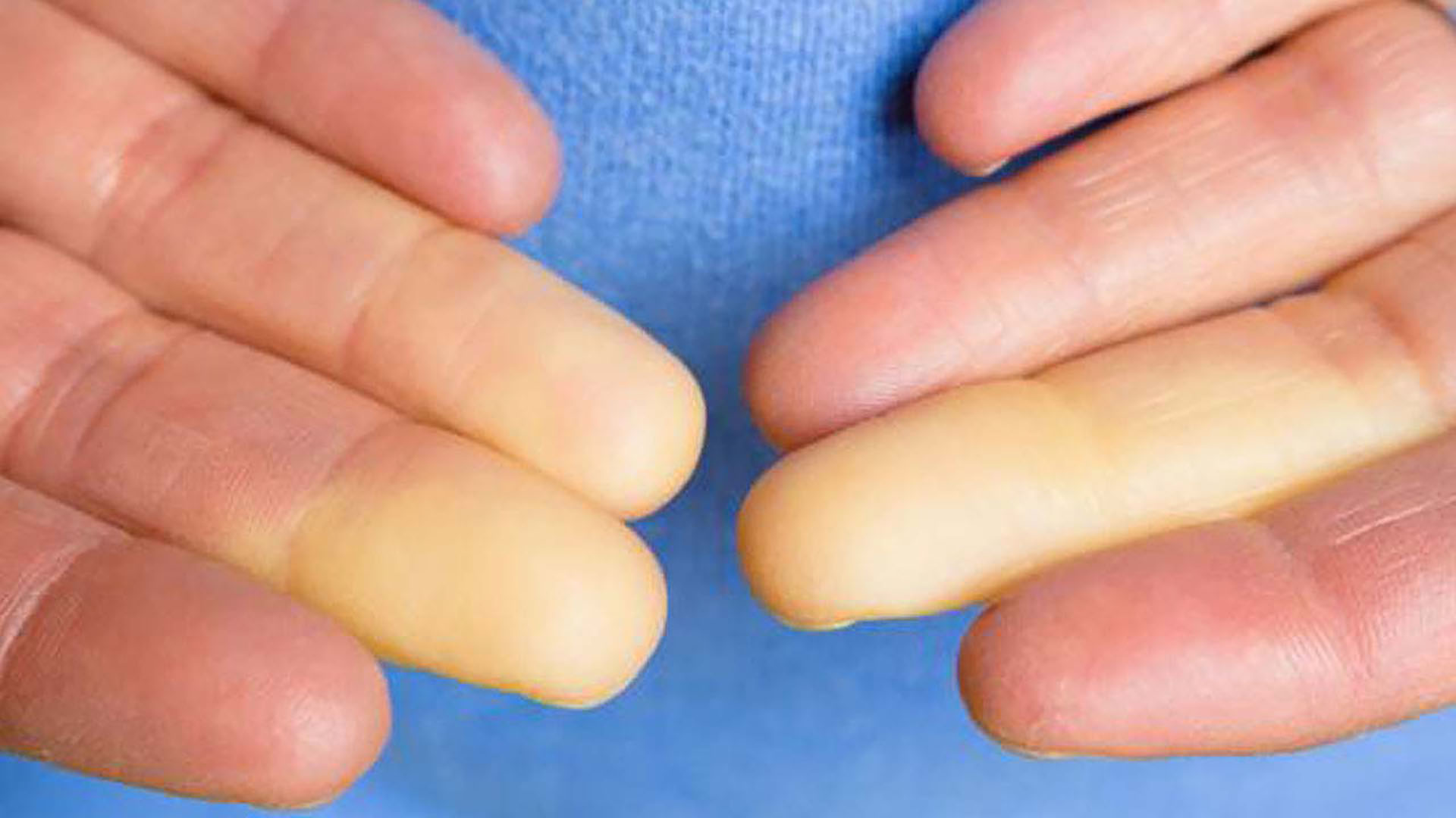 Raynauds fenomen