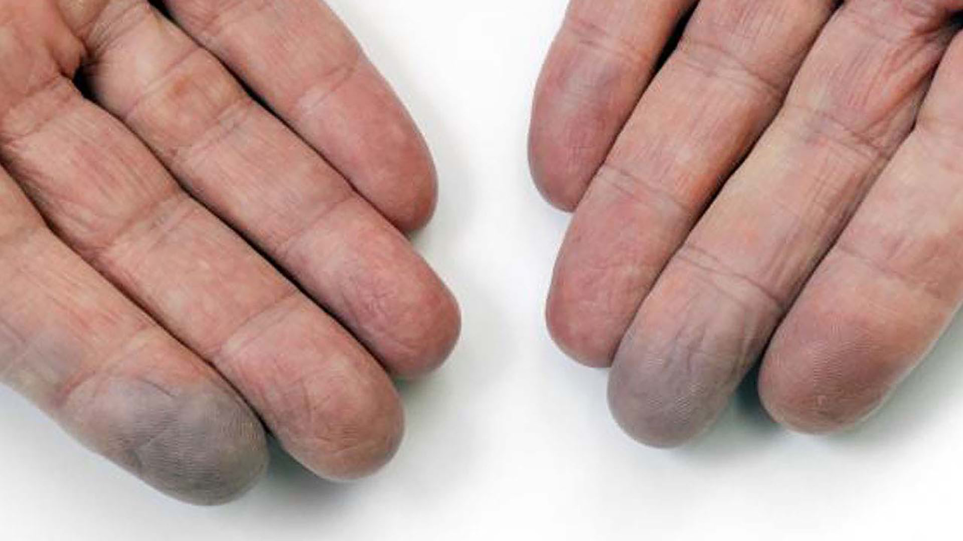 Raynauds fenomen