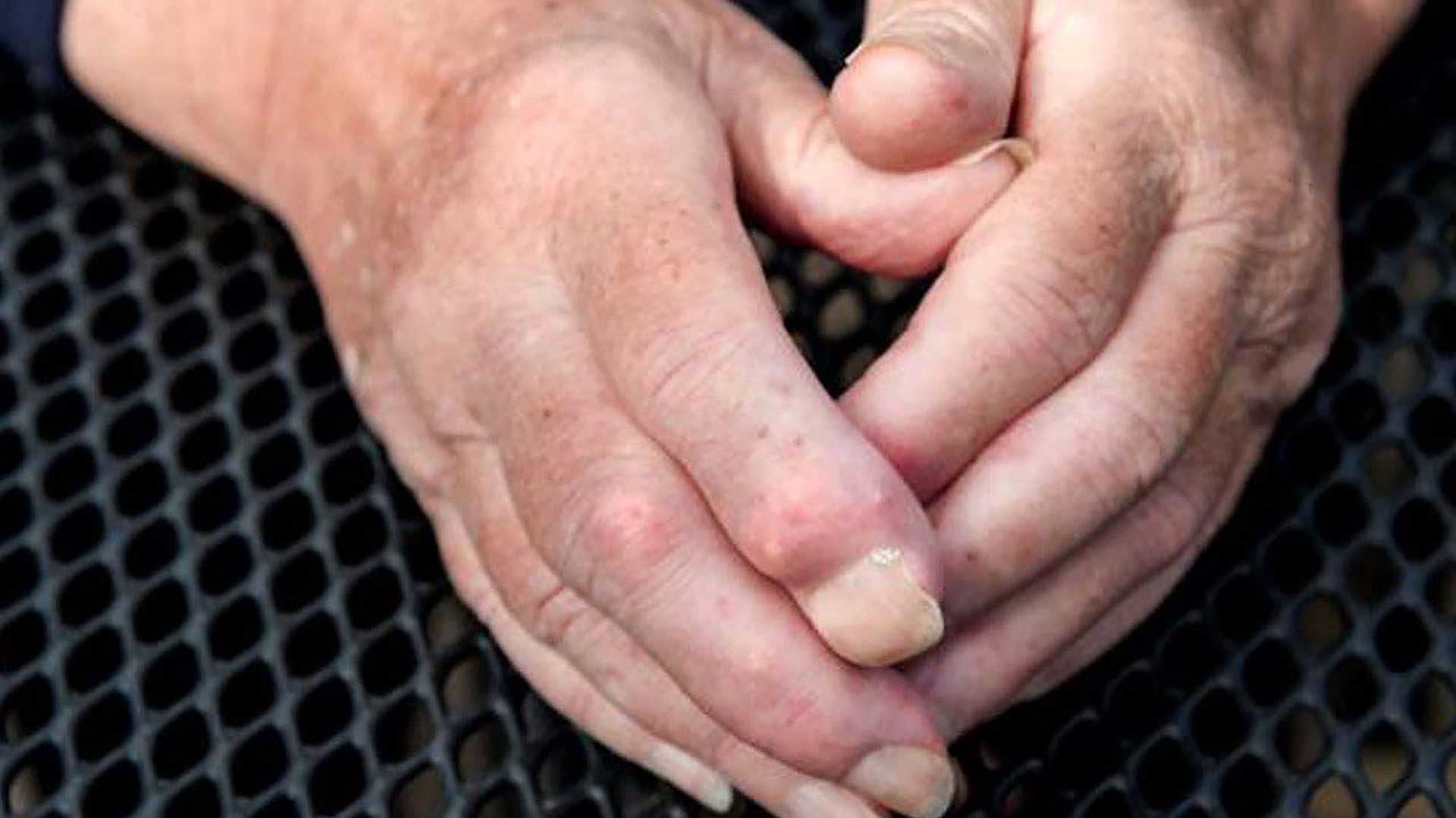 Hårda knölar (kalcinos)